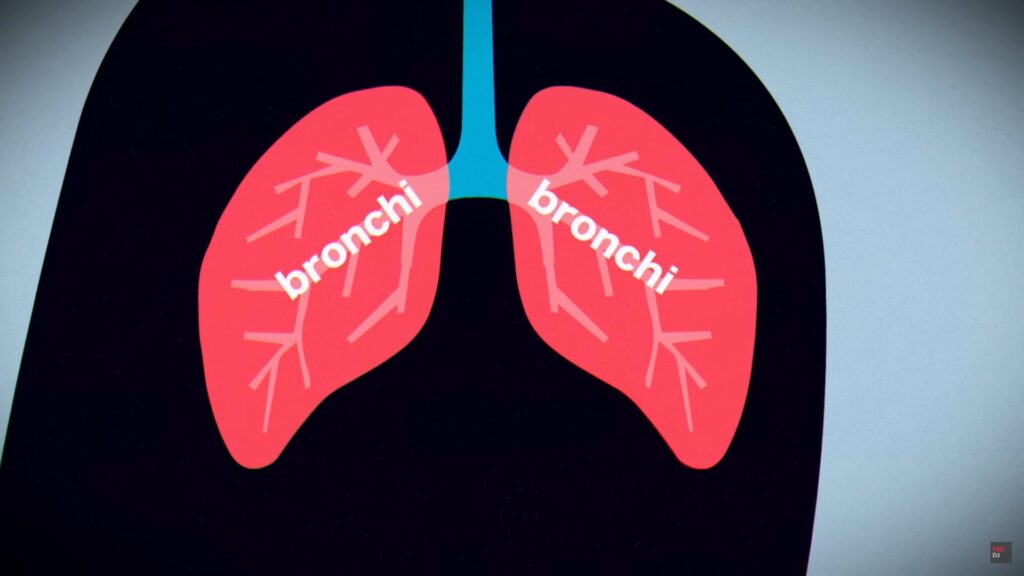 Pneumonia Complications