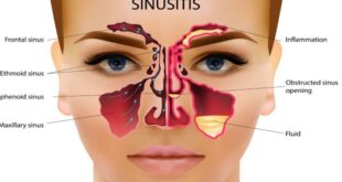 Sinus congestion relief
