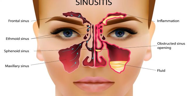 Sinus congestion relief